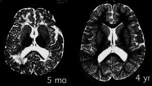 myelination 2